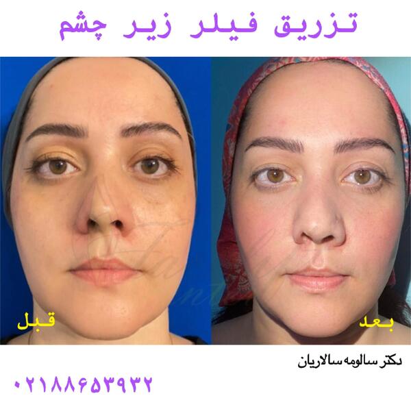 عکس قبل و بعد عمل لیفت صورت