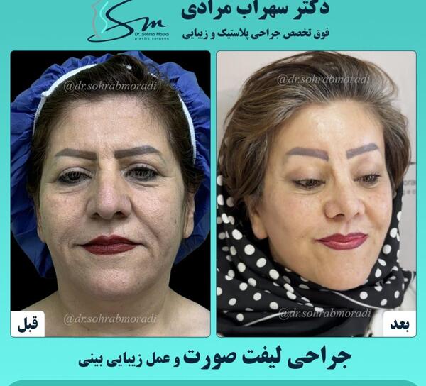 عکس قبل و بعد عمل لیفت صورت