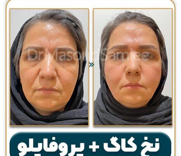 عکس قبل و بعد عمل لیفت صورت