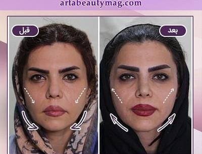 عکس قبل و بعد عمل لیفت صورت
