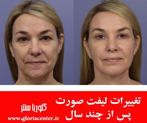 عکس قبل و بعد از لیفت صورت
