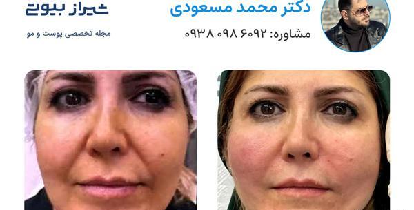 عکس قبل و بعد از لیفت صورت