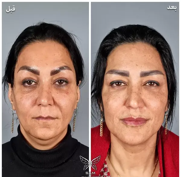 عکس قبل و بعد از لیفت صورت