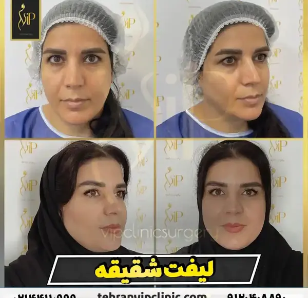 عکس قبل و بعد از لیفت صورت