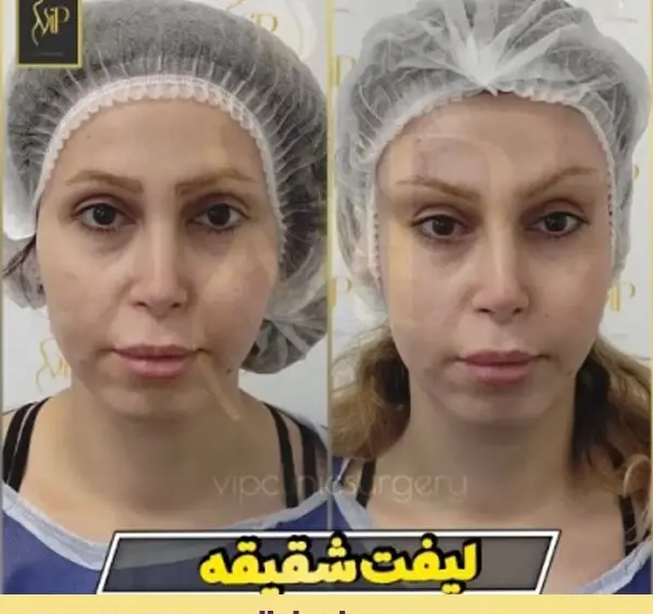 عکس قبل و بعد از لیفت صورت