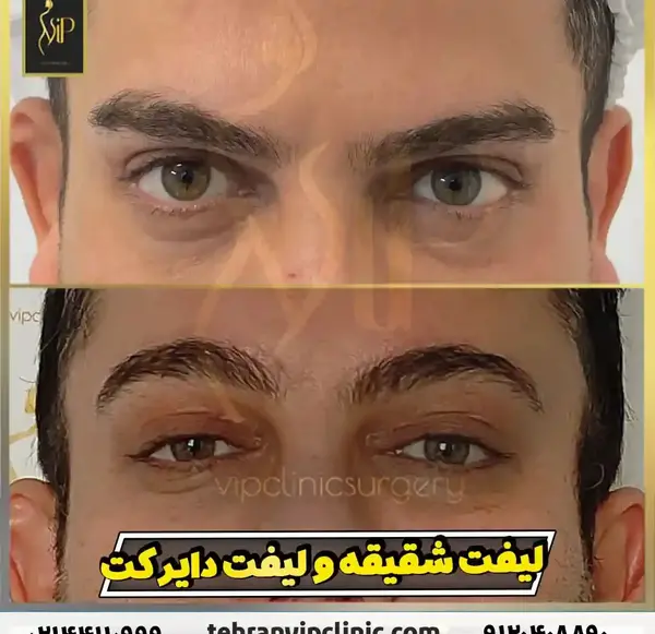 عکس قبل و بعد از لیفت صورت