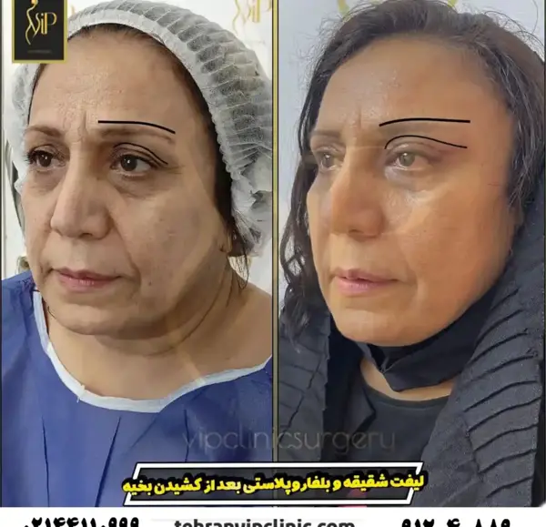 عکس قبل و بعد از لیفت صورت
