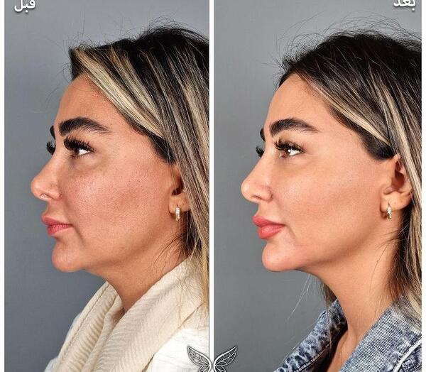 عکس قبل و بعد از لیفت صورت