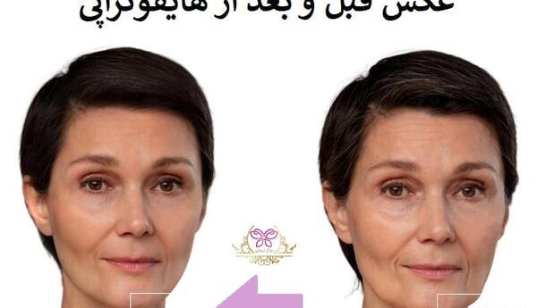 عکس قبل و بعد از لیفت صورت