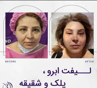 عکس قبل و بعد از لیفت صورت