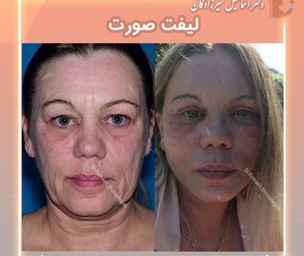 عکس قبل و بعد از لیفت صورت