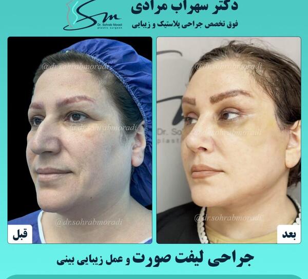 عکس قبل و بعد از لیفت صورت