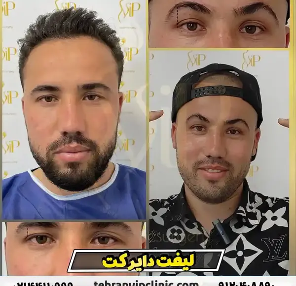 عکس قبل و بعد از لیفت صورت