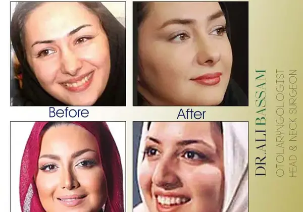 عکس قبل و بعد عمل انجلینا جولی