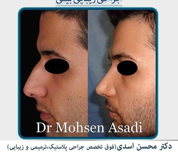 عکس قبل از عمل دماغ محسن یگانه