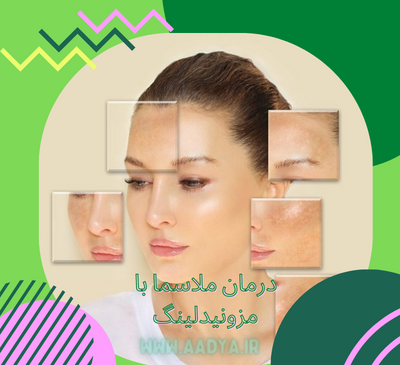 عکس قبل و بعد مزونیدلینگ نی نی سایت