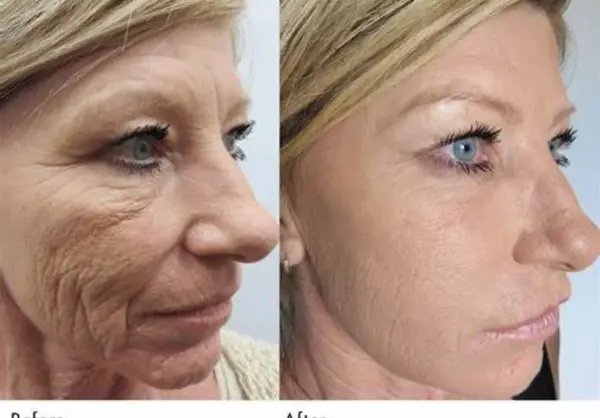عکس قبل و بعد مزونیدلینگ نی نی سایت