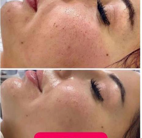 عکس قبل و بعد مزونیدلینگ نی نی سایت