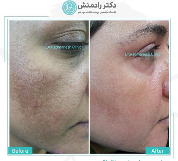 عکس قبل و بعد مزونیدلینگ نی نی سایت