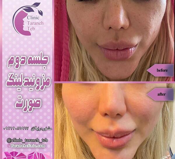 عکس قبل و بعد مزونیدلینگ نی نی سایت