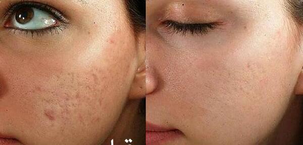 عکس قبل و بعد مزونیدلینگ نی نی سایت