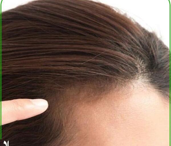 عکس قبل و بعد مزونیدلینگ مو