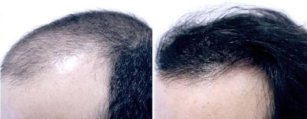 عکس قبل و بعد مزونیدلینگ مو
