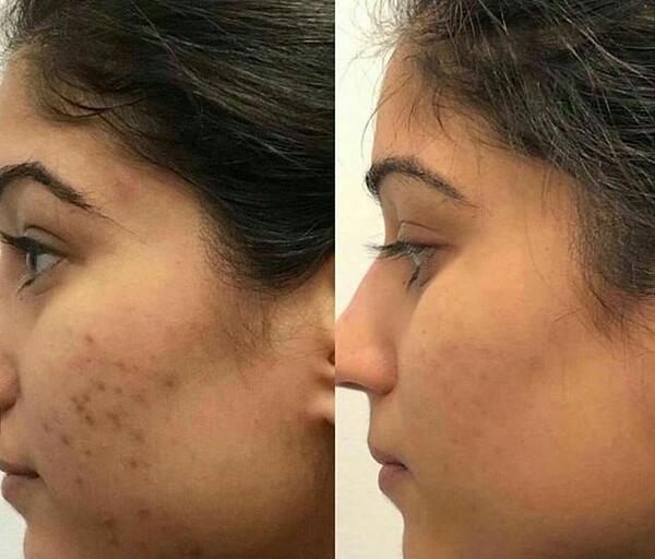 عکس قبل و بعد مزونیدلینگ مو