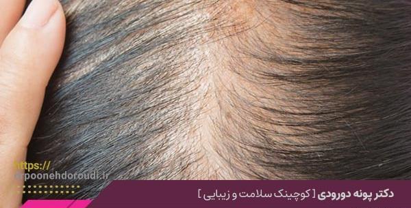عکس قبل و بعد مزونیدلینگ مو