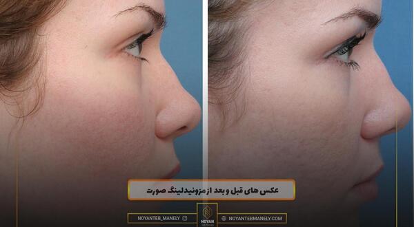عکس قبل و بعد مزونیدلینگ مو