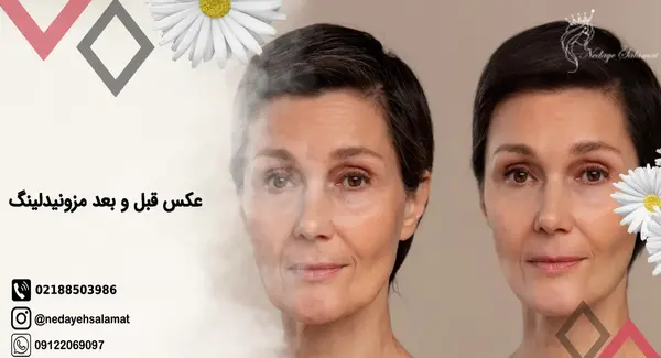 عکس قبل و بعد مزونیدلینگ مو