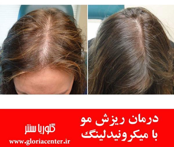 عکس قبل و بعد مزونیدلینگ مو