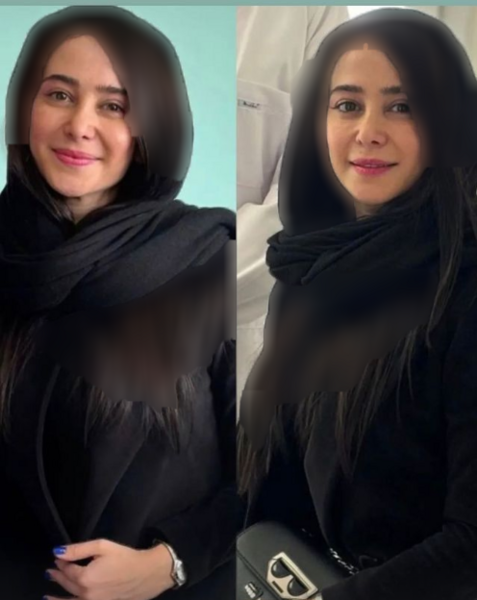 عکس قبل از عمل بینی الناز حبیبی
