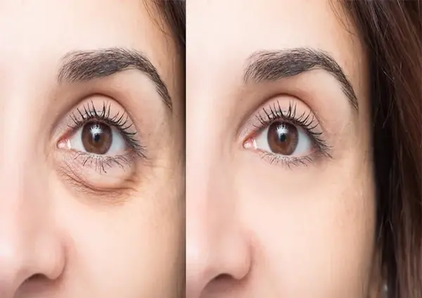 عکس قبل بعد فیلر زیر چشم