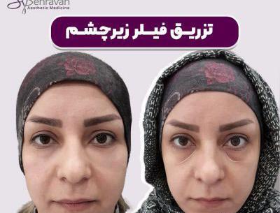 عکس قبل بعد فیلر زیر چشم