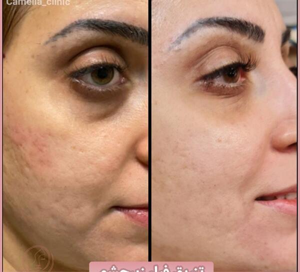 عکس قبل بعد فیلر زیر چشم