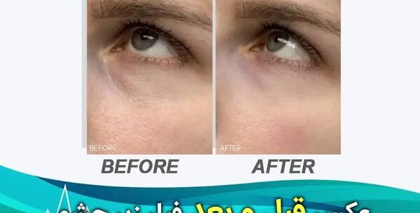 عکس قبل بعد فیلر زیر چشم