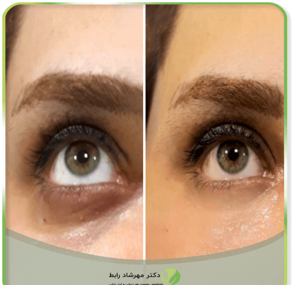 عکس قبل بعد فیلر زیر چشم