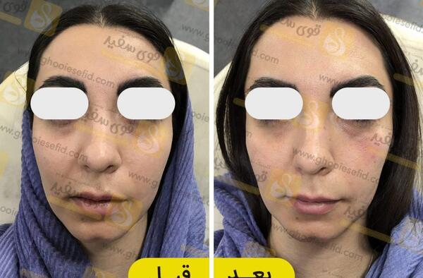 عکس قبل بعد فیلر زیر چشم