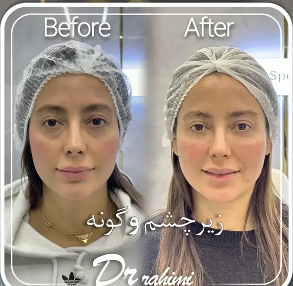عکس قبل بعد فیلر زیر چشم