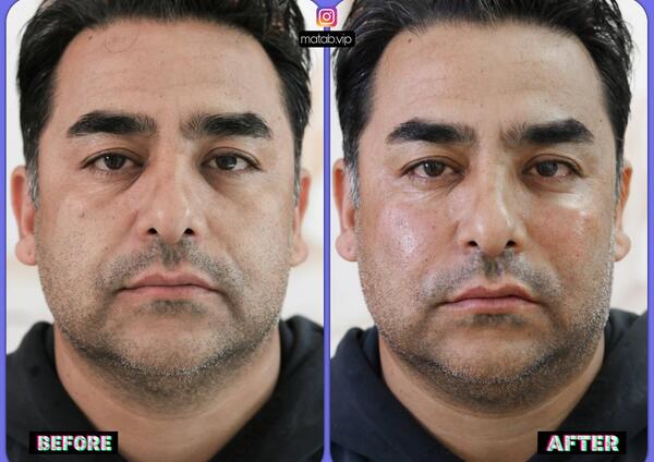عکس قبل بعد فیلر زیر چشم