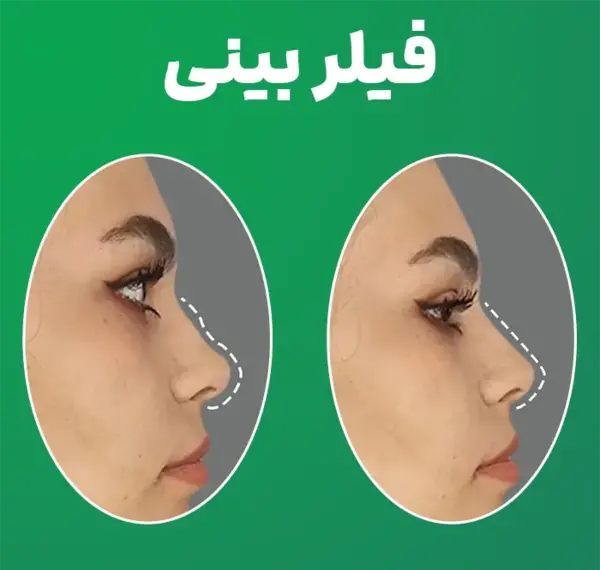 عکس قبل بعد فیلر بینی