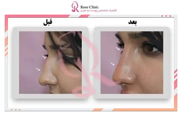عکس قبل بعد فیلر بینی