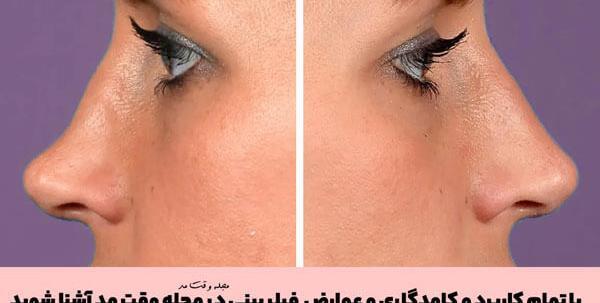 عکس قبل بعد فیلر بینی