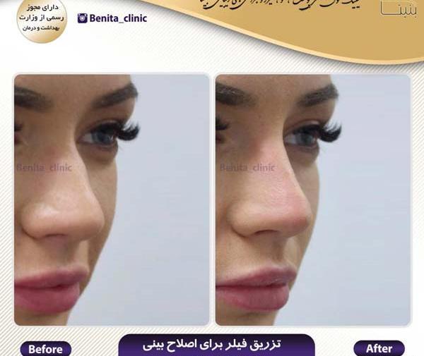 عکس قبل بعد فیلر بینی