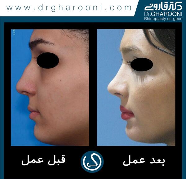 عکس قبل بعد فیلر بینی