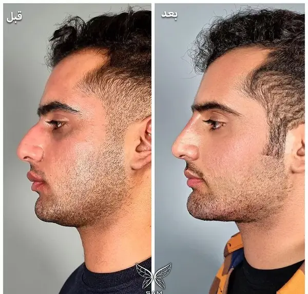 عکس قبل بعد فیلر بینی