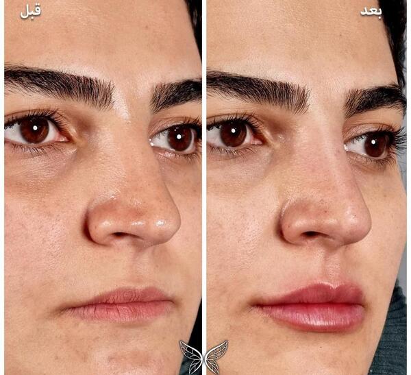 عکس قبل بعد فیلر بینی