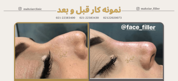 عکس قبل بعد فیلر بینی