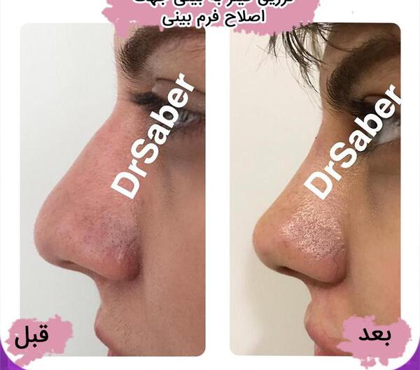 عکس قبل بعد فیلر بینی